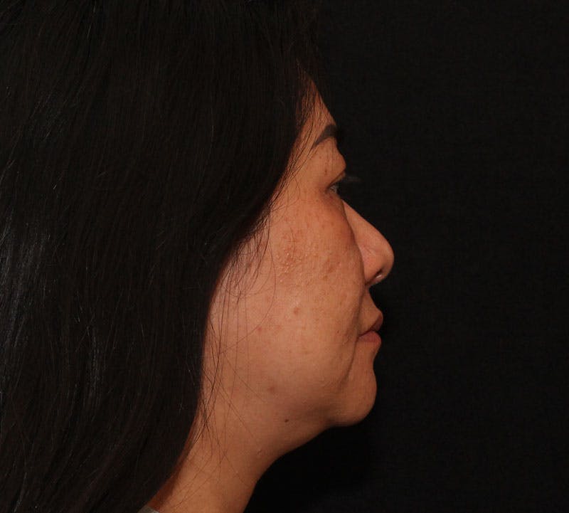 Browlift/Upper Blepharoplasty Before & After Gallery - Patient 242822 - Image 5