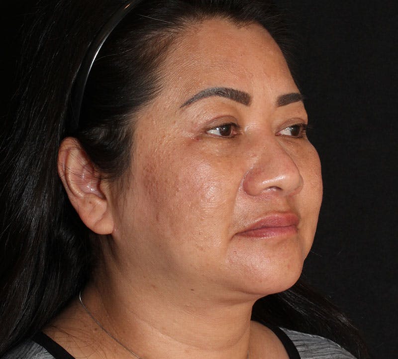 Browlift/Upper Blepharoplasty Before & After Gallery - Patient 242822 - Image 4