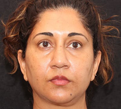 Browlift/Upper Blepharoplasty Before & After Gallery - Patient 113129 - Image 1
