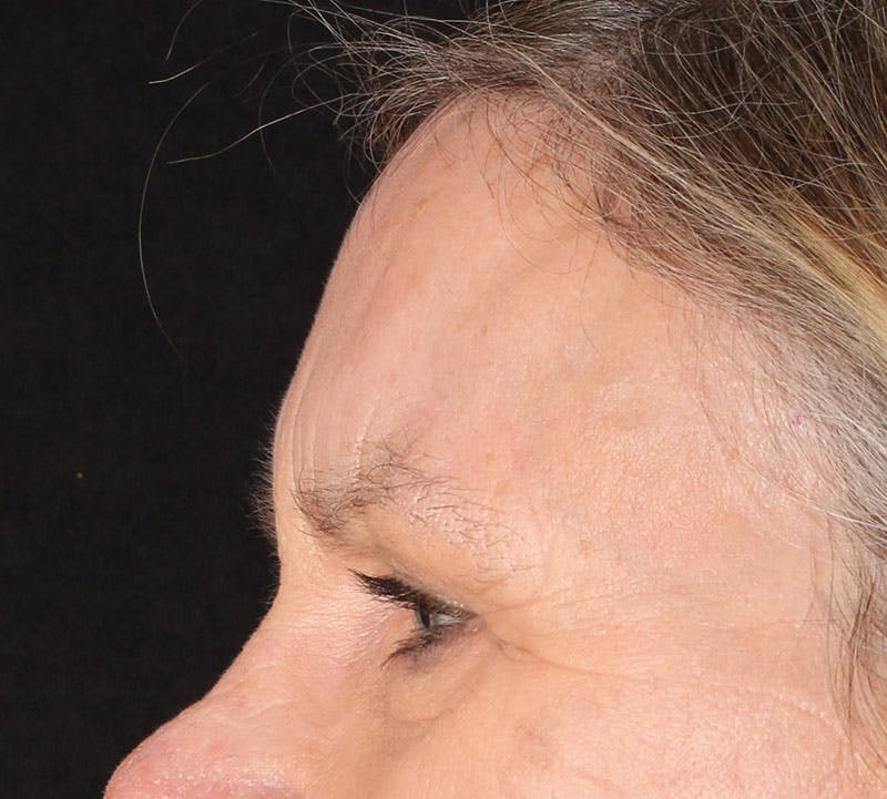 Browlift/Upper Blepharoplasty Before & After Gallery - Patient 238537 - Image 8