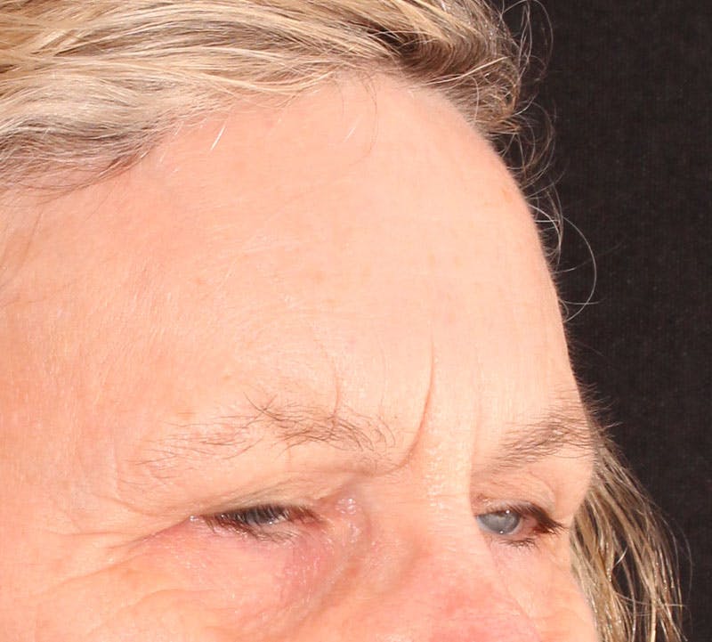 Browlift/Upper Blepharoplasty Before & After Gallery - Patient 238537 - Image 3