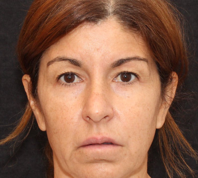 Browlift/Upper Blepharoplasty Before & After Gallery - Patient 167722 - Image 1