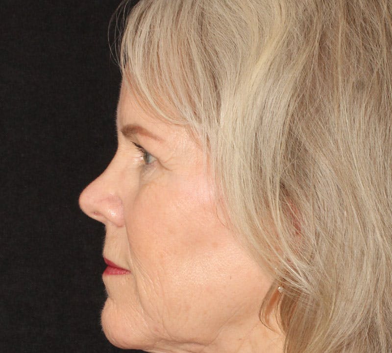 Browlift/Upper Blepharoplasty Before & After Gallery - Patient 330726 - Image 8