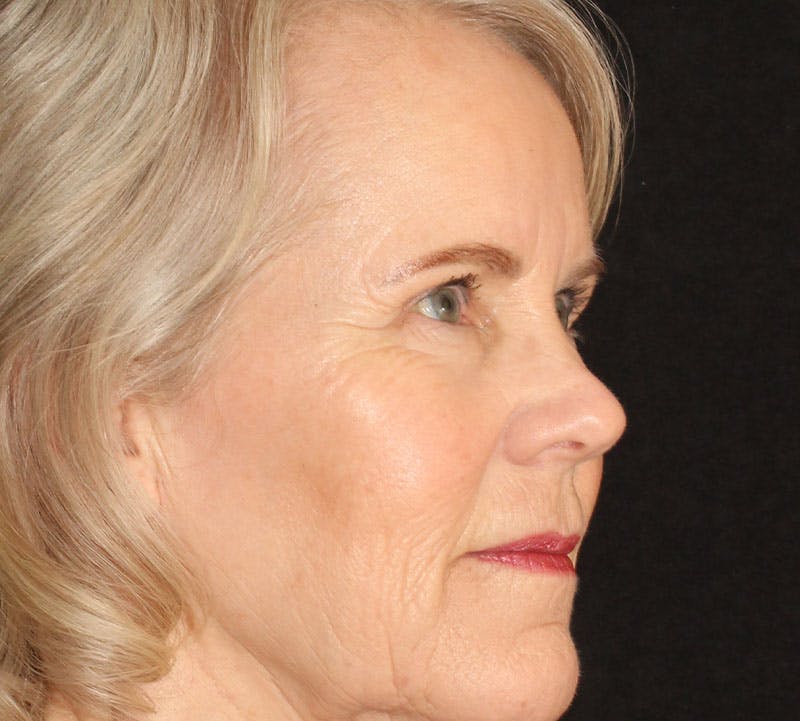 Browlift/Upper Blepharoplasty Before & After Gallery - Patient 330726 - Image 4