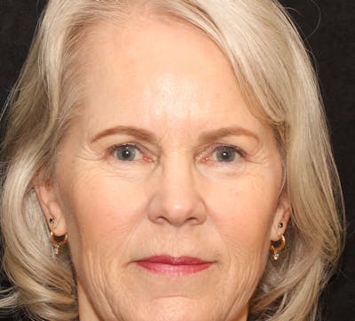 Browlift/Upper Blepharoplasty Before & After Gallery - Patient 330726 - Image 2