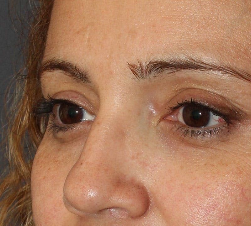 Lower Blepharoplasty Before & After Gallery - Patient 298052 - Image 10