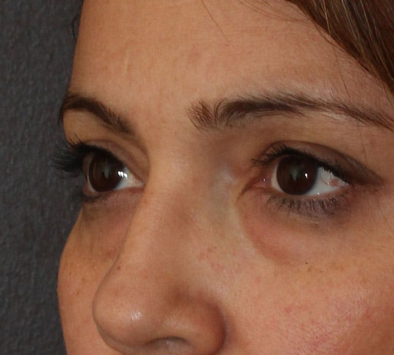 Lower Blepharoplasty Before & After Gallery - Patient 298052 - Image 9