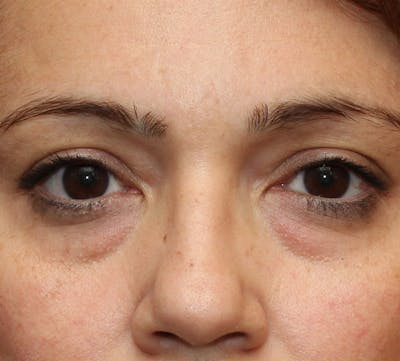 Lower Blepharoplasty Before & After Gallery - Patient 298052 - Image 1