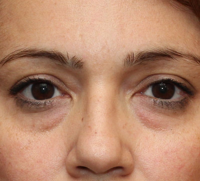 Lower Blepharoplasty Before & After Gallery - Patient 298052 - Image 1