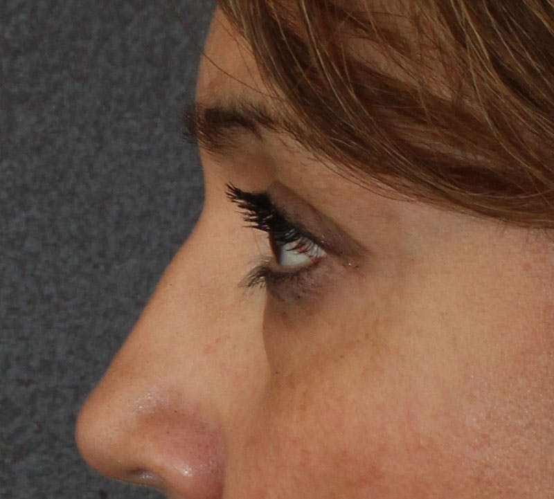 Lower Blepharoplasty Before & After Gallery - Patient 298052 - Image 7