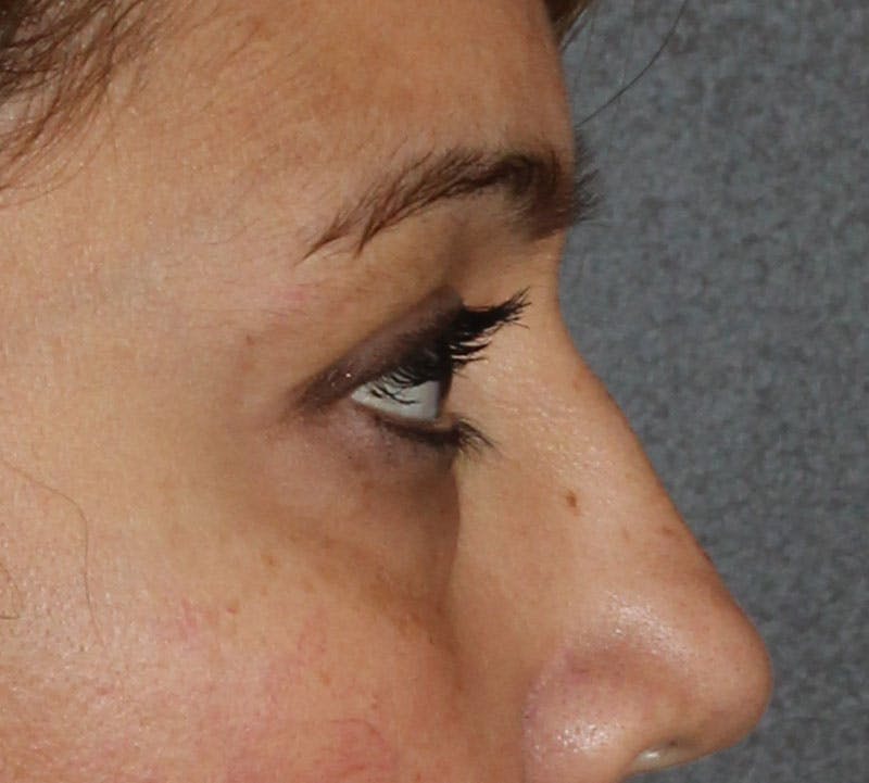 Lower Blepharoplasty Before & After Gallery - Patient 298052 - Image 5