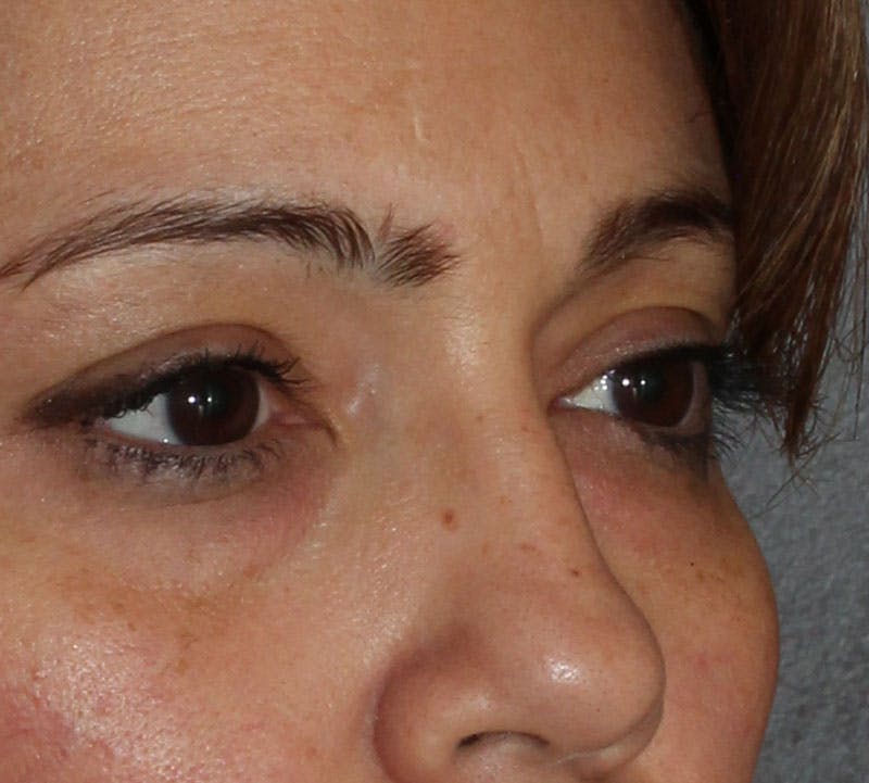 Lower Blepharoplasty Before & After Gallery - Patient 298052 - Image 3