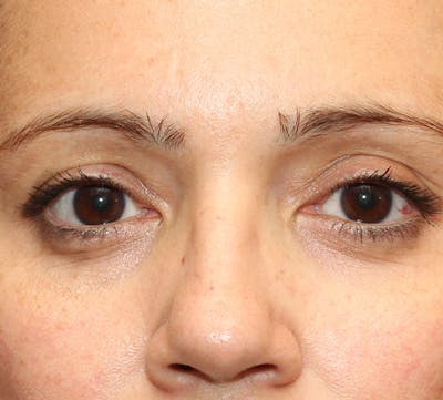 Lower Blepharoplasty Before & After Gallery - Patient 298052 - Image 2