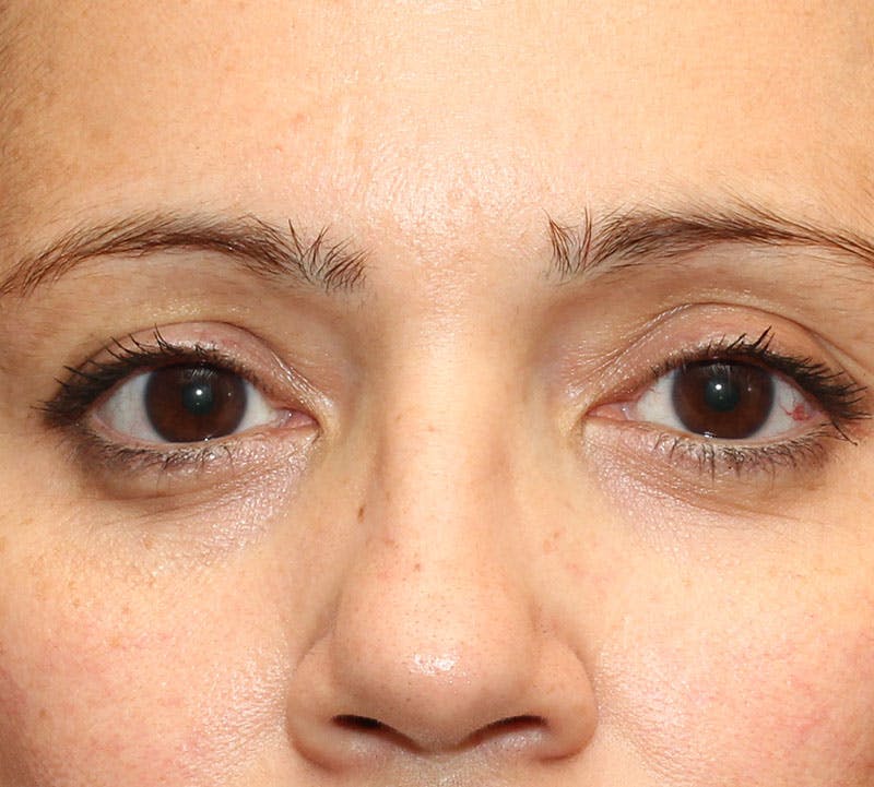 Lower Blepharoplasty Before & After Gallery - Patient 298052 - Image 2