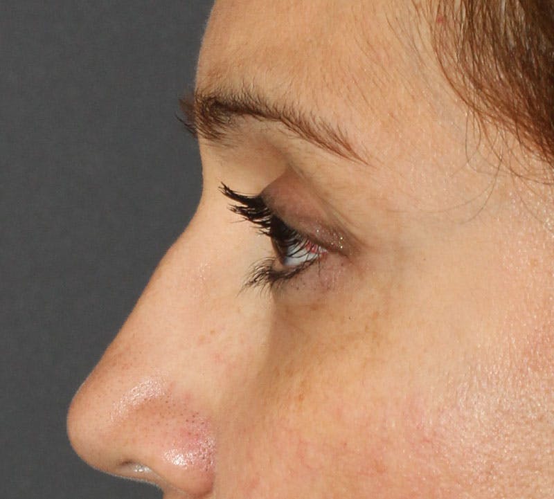 Lower Blepharoplasty Before & After Gallery - Patient 298052 - Image 8