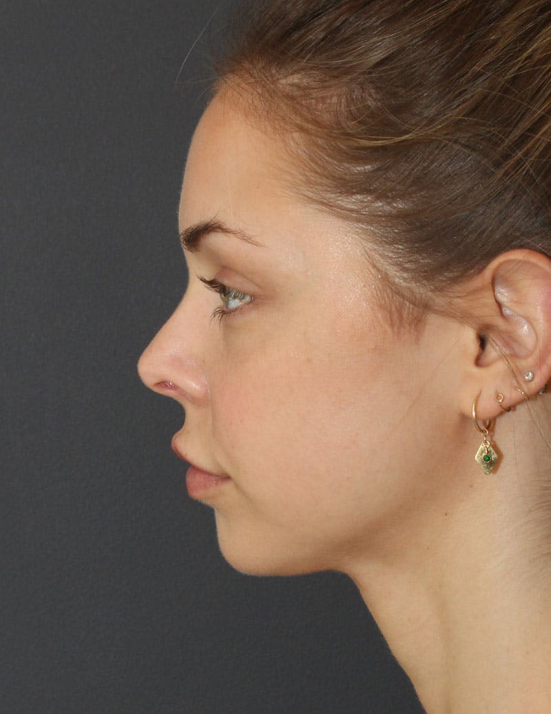 Facetite Before & After Gallery - Patient 277490 - Image 8