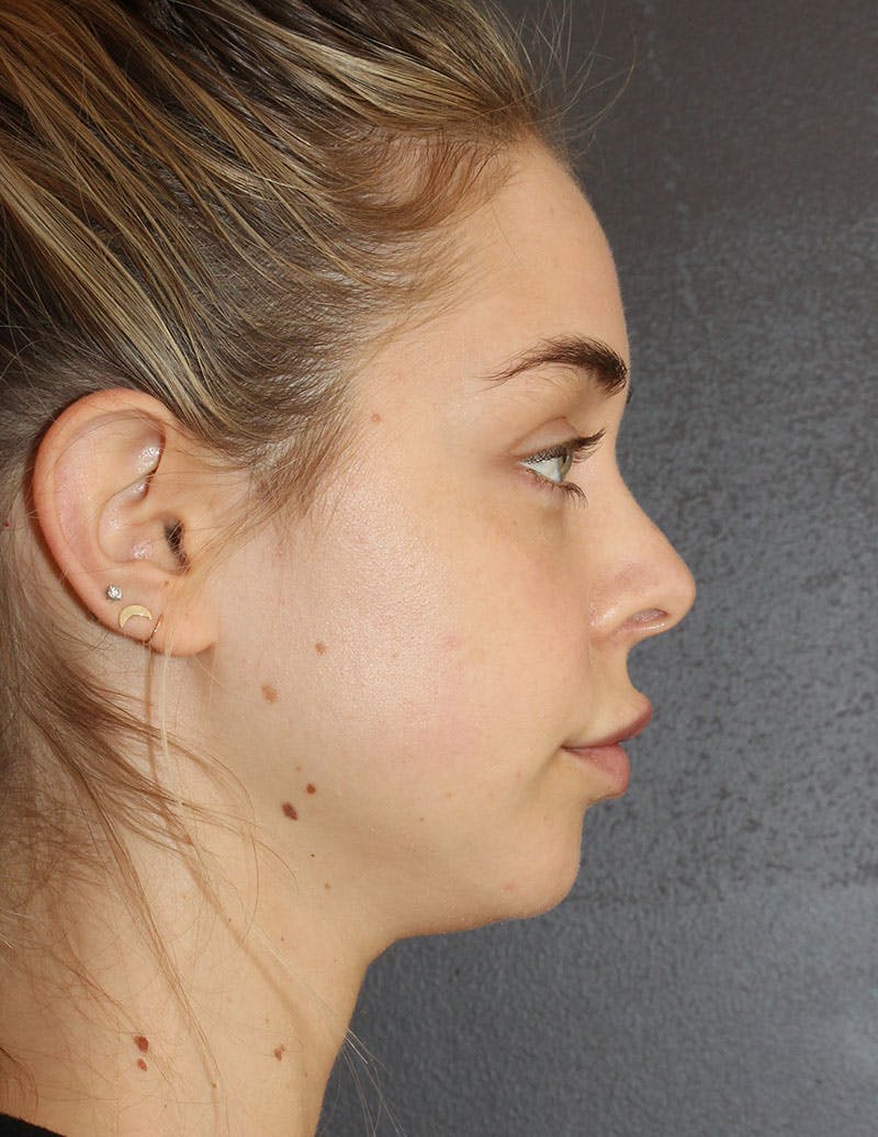 Facetite Before & After Gallery - Patient 277490 - Image 5