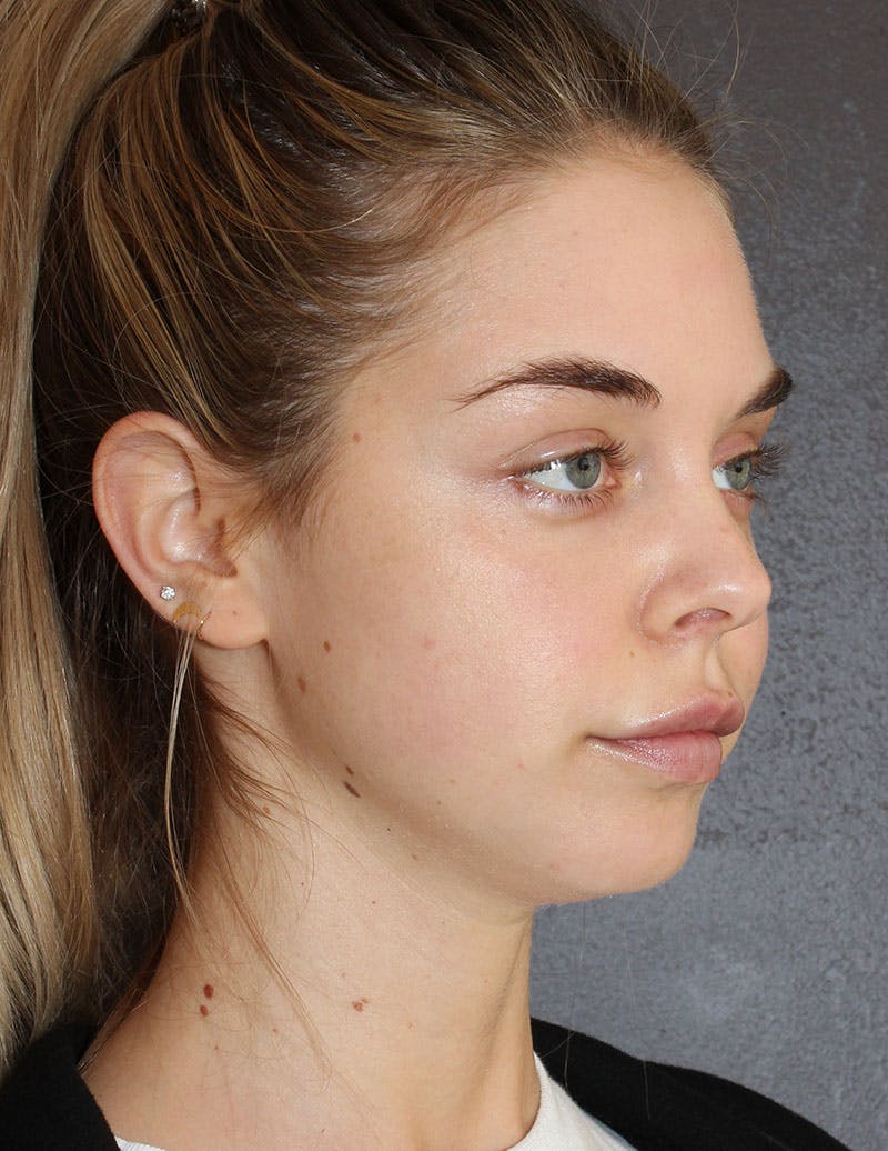 Facetite Before & After Gallery - Patient 277490 - Image 3