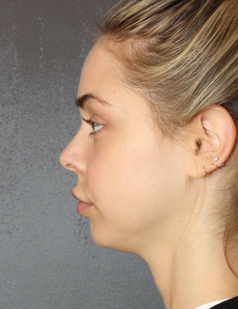 Facetite Before & After Gallery - Patient 277490 - Image 7
