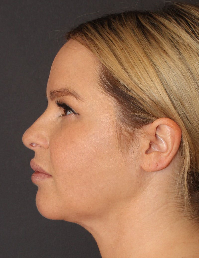 Facetite Before & After Gallery - Patient 330224 - Image 8