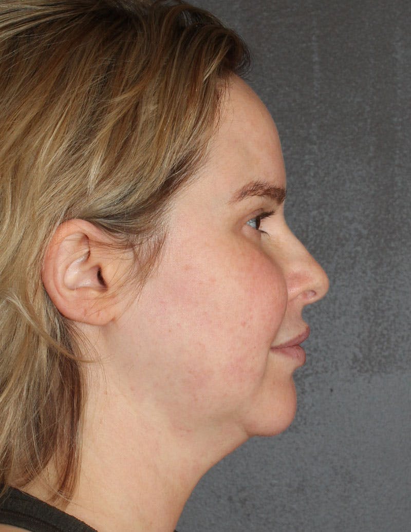 Facetite Before & After Gallery - Patient 330224 - Image 5