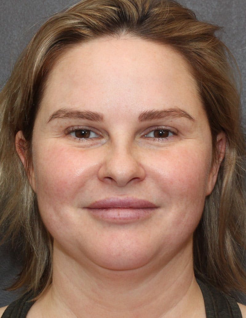 Facetite Before & After Gallery - Patient 330224 - Image 1