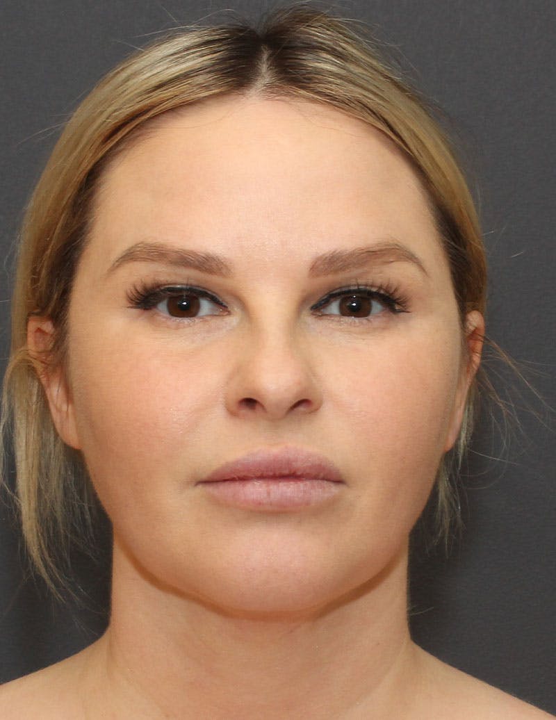 Facetite Before & After Gallery - Patient 330224 - Image 2