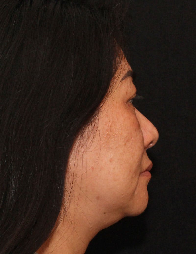 Facetite Before & After Gallery - Patient 200072 - Image 5