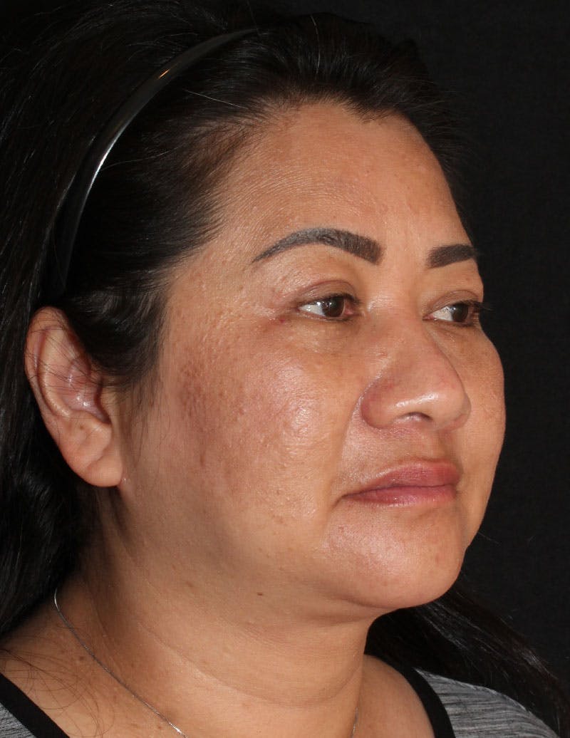 Facetite Before & After Gallery - Patient 200072 - Image 4