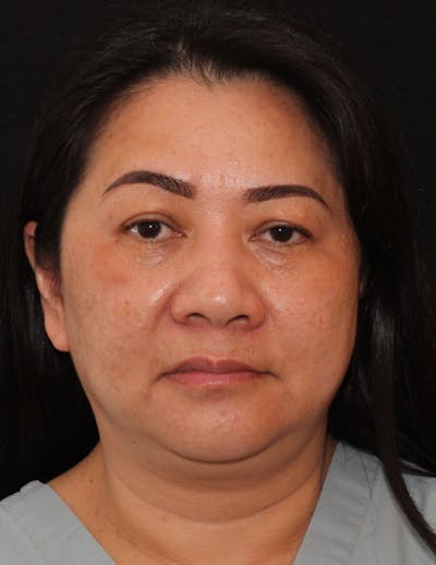 Facetite Before & After Gallery - Patient 200072 - Image 1