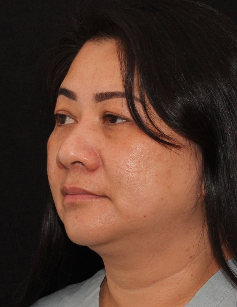 Facetite Before & After Gallery - Patient 200072 - Image 9