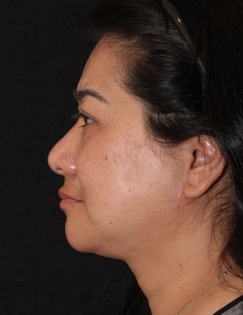 Facetite Before & After Gallery - Patient 200072 - Image 8
