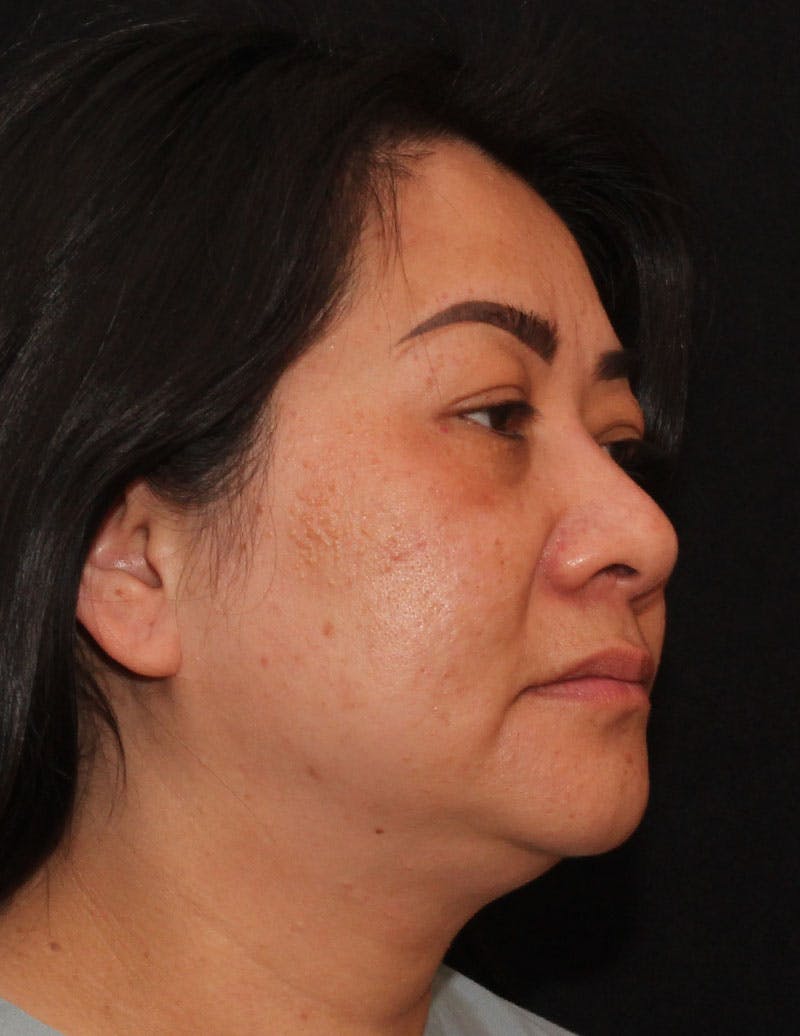 Facetite Before & After Gallery - Patient 200072 - Image 3