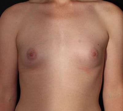 Transgender Breast Augmentation Before & After Gallery - Patient 426446 - Image 1