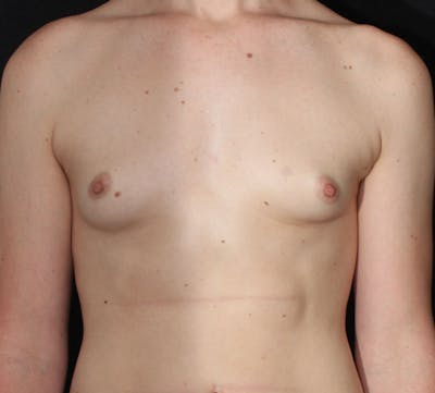 Transgender Breast Augmentation Before & After Gallery - Patient 363980 - Image 1