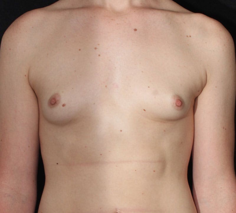 Transgender Breast Augmentation Before & After Gallery - Patient 363980 - Image 1