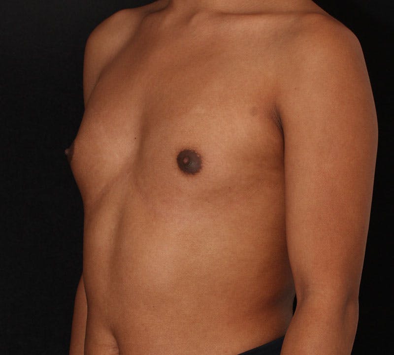 Transgender Breast Augmentation Before & After Gallery - Patient 109790 - Image 9