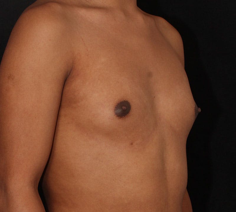 Transgender Breast Augmentation Before & After Gallery - Patient 109790 - Image 3