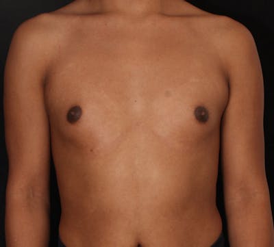 Transgender Breast Augmentation Before & After Gallery - Patient 109790 - Image 1