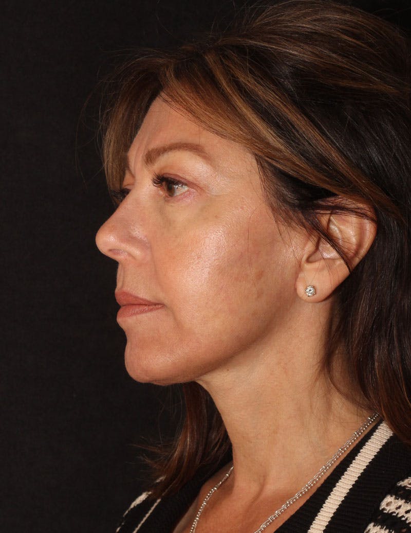 Facelift/Necklift Before & After Gallery - Patient 215928 - Image 10