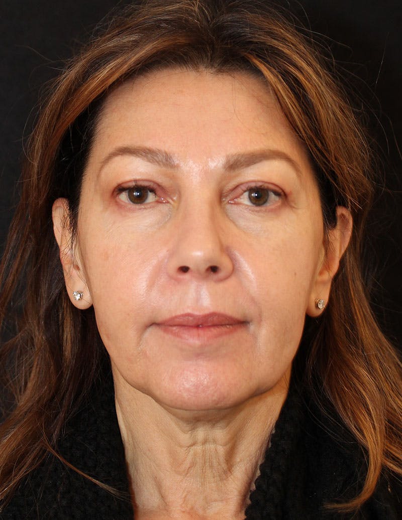 Facelift/Necklift Before & After Gallery - Patient 215928 - Image 1