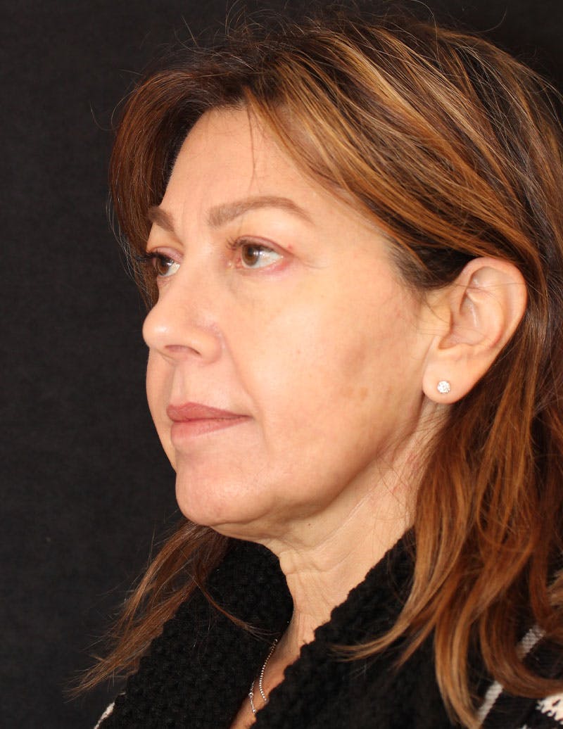 Facelift/Necklift Before & After Gallery - Patient 215928 - Image 9