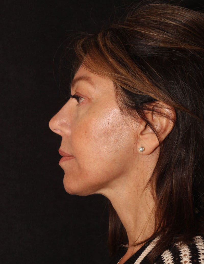 Facelift/Necklift Before & After Gallery - Patient 215928 - Image 8