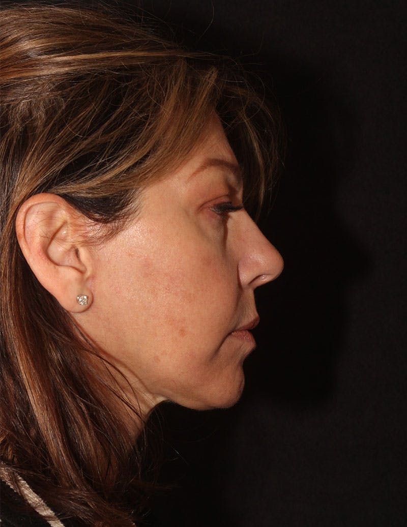 Facelift/Necklift Before & After Gallery - Patient 215928 - Image 6