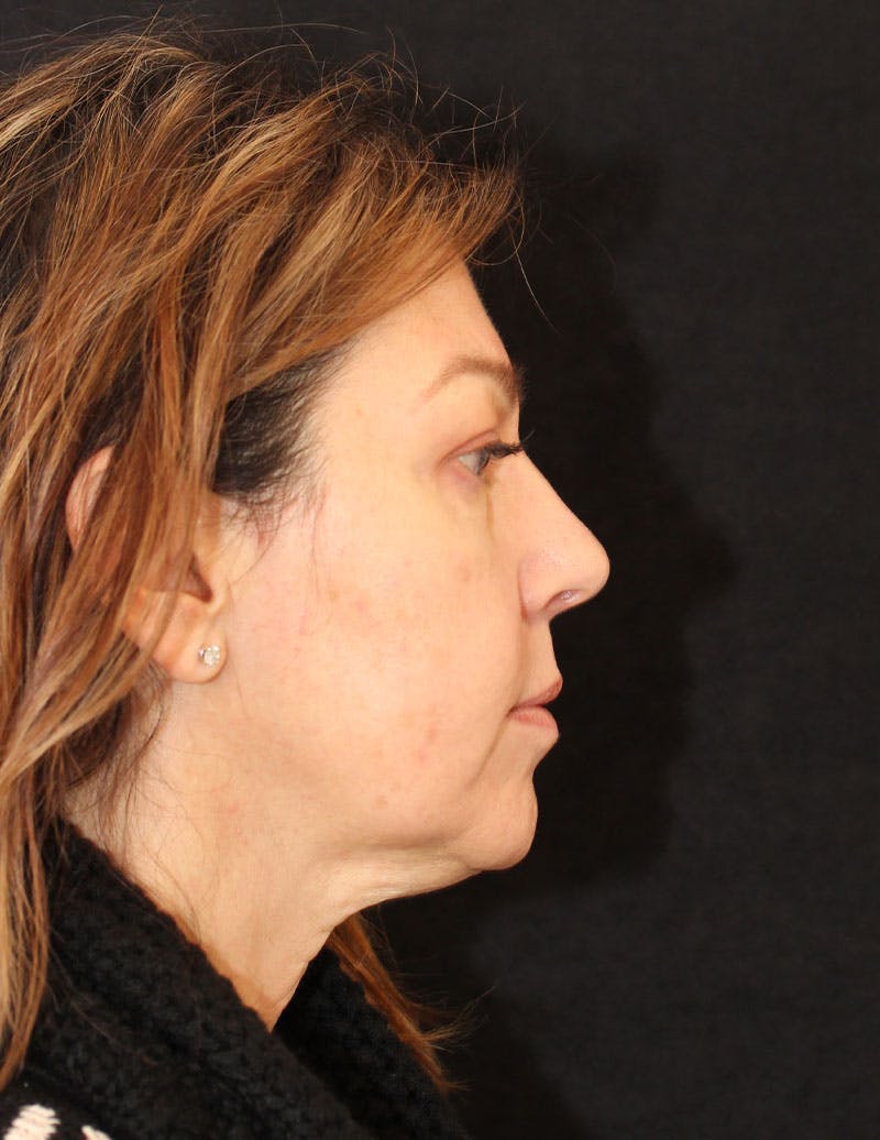 Facelift/Necklift Before & After Gallery - Patient 215928 - Image 5