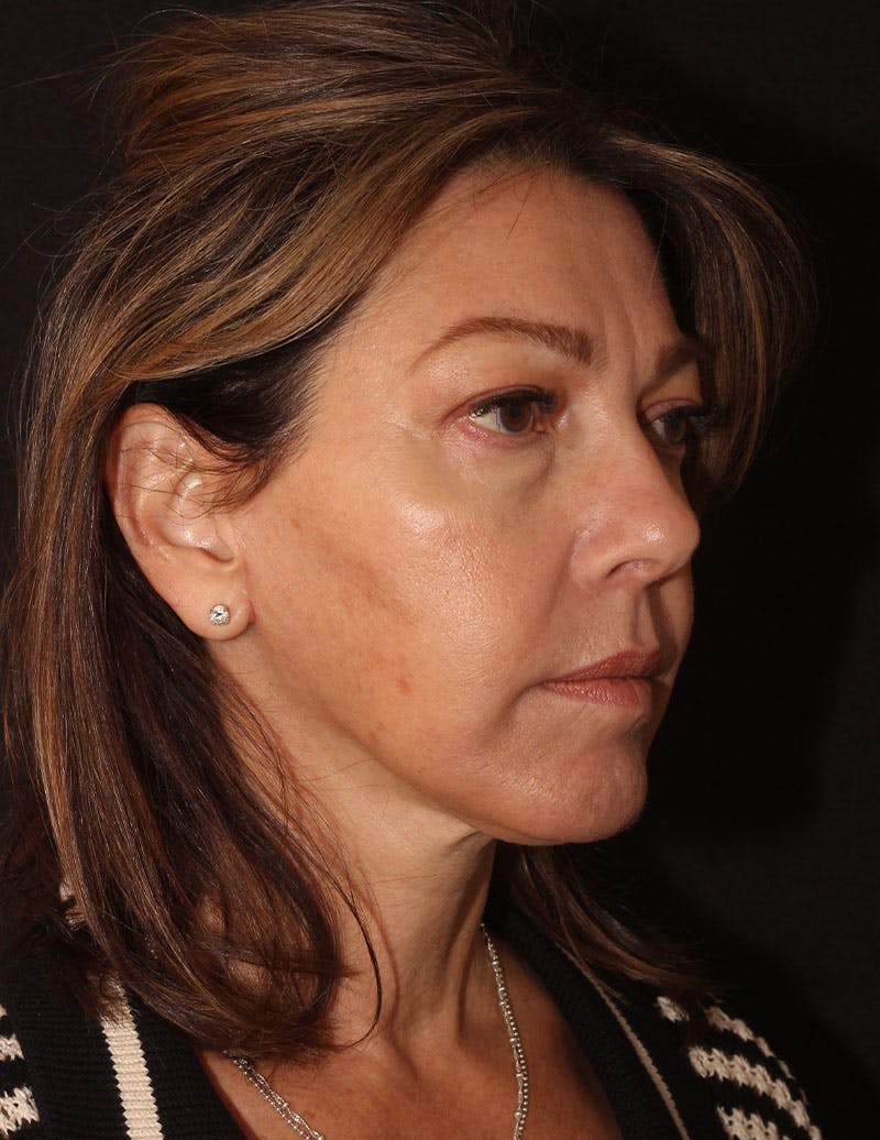 Facelift/Necklift Before & After Gallery - Patient 215928 - Image 4