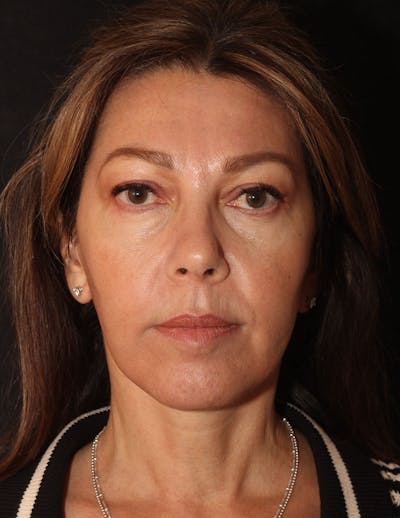 Facelift/Necklift Before & After Gallery - Patient 215928 - Image 2