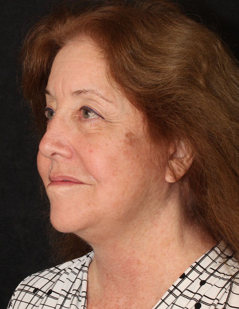 Facelift/Necklift Before & After Gallery - Patient 487195 - Image 10