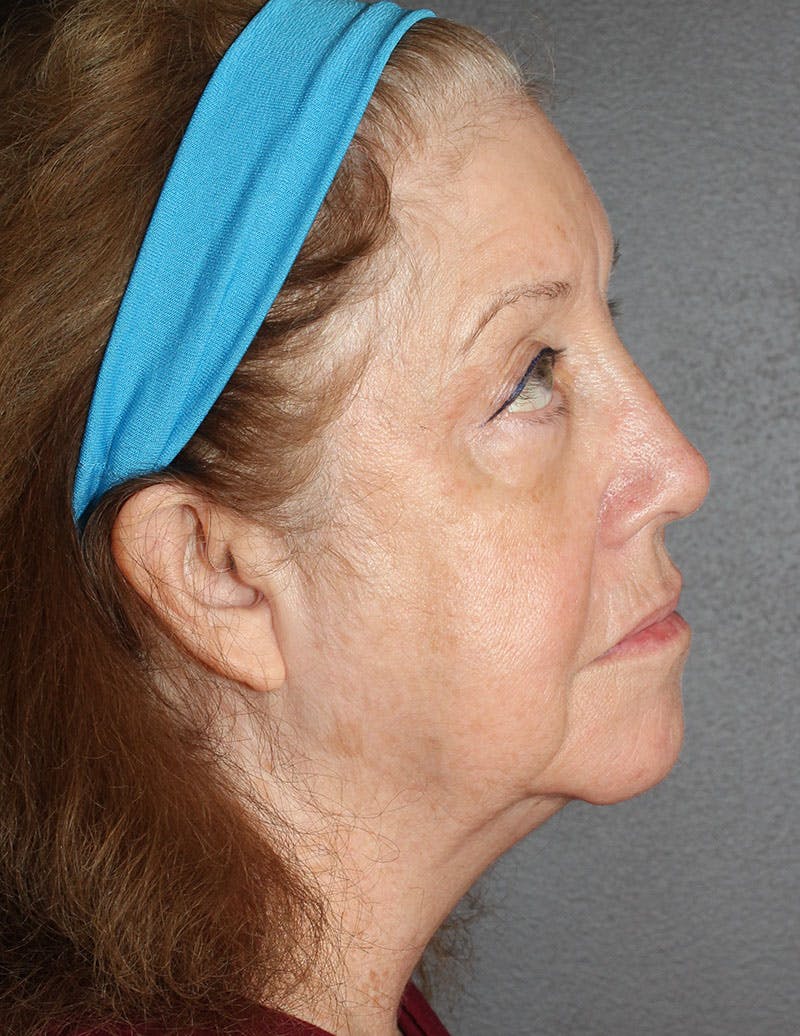Facelift/Necklift Before & After Gallery - Patient 487195 - Image 3