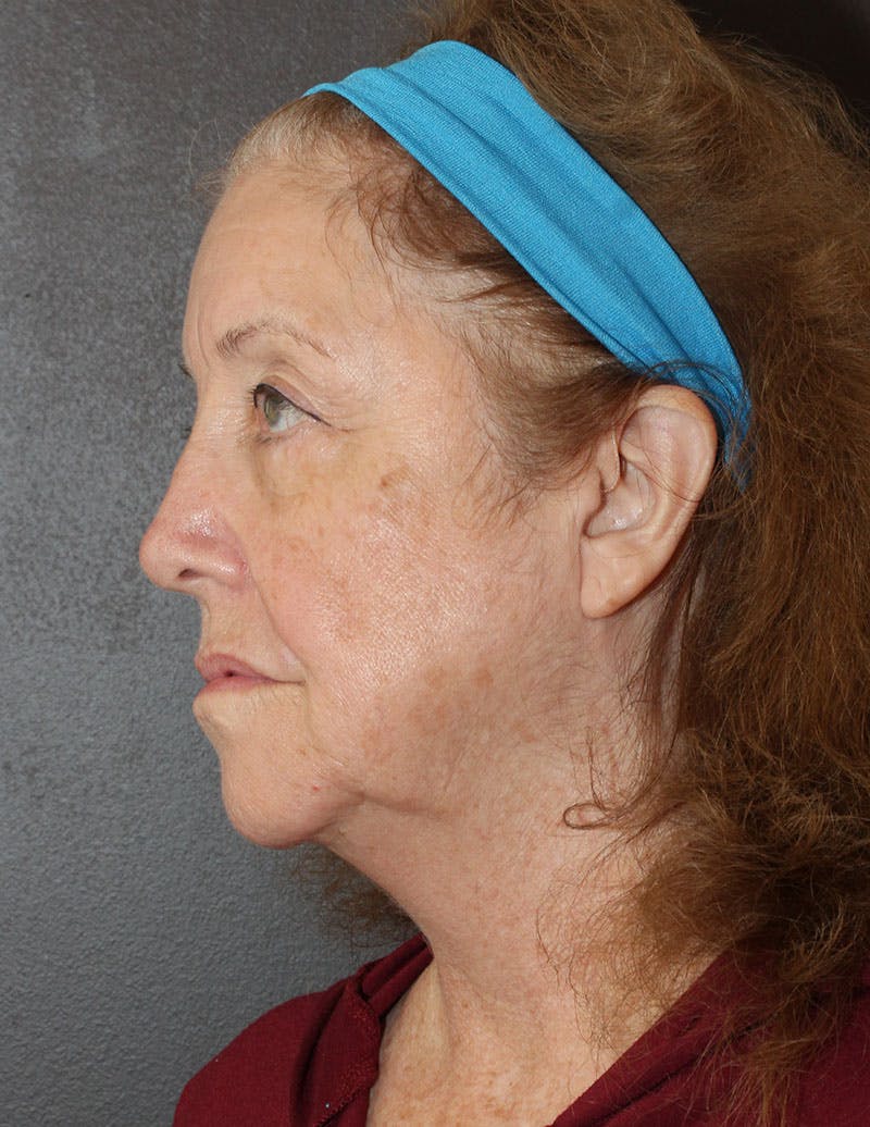 Facelift/Necklift Before & After Gallery - Patient 487195 - Image 9